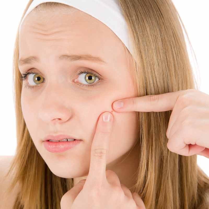 Rimedi naturali contro l'acne 